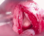 Picture of Vocal Cords after Removal of Polyps