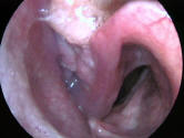 Picture of a Larynx and Pyriform Sinus Cancer