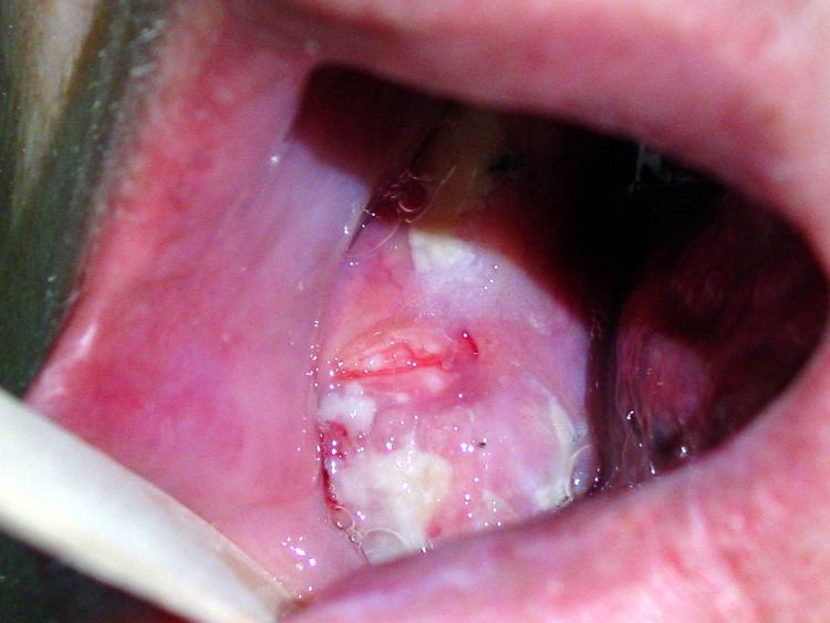 Intra oral picture of jaw and floor of mouth tumor