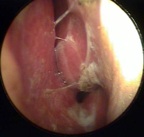polyps in nose. of their nose and quitting
