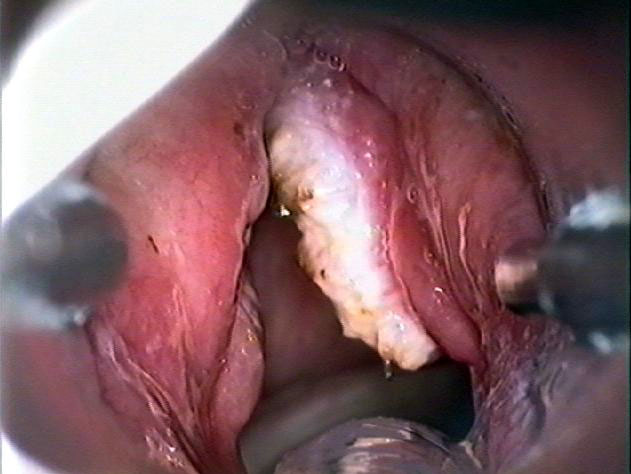 T1 Verrucous Carcinoma of the Larynx