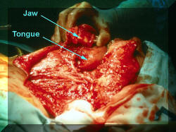 Commando Operation - Jaw-Tongue-Neck Resection