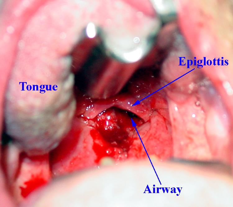 Large Cancer of the Hypopharyxn Causing Airway Obstruction