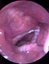 Picture of a T2 Cancer of the Larynx - Squamous Cell Carcinoma