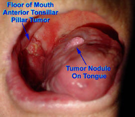 Squamous Cell Carcinoma of the Floor of Mouth and Tongue