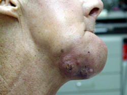 Lateral  picture of jaw and floor of mouth tumor eroding through skin