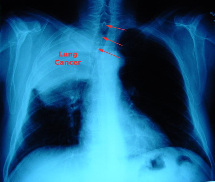 Chest X-Ray of a right lung cancer with deviaition of the trachea (wind pipe).