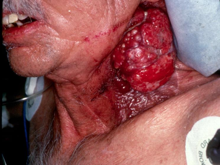Large Recurrent Neck Tumor from Squamous Cell Carcinoma